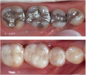 CEREC restorations before and after