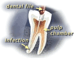 root canal dental file