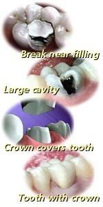 large dental cavity