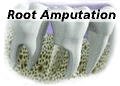 root amputation
