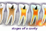 stages of a dental cavity